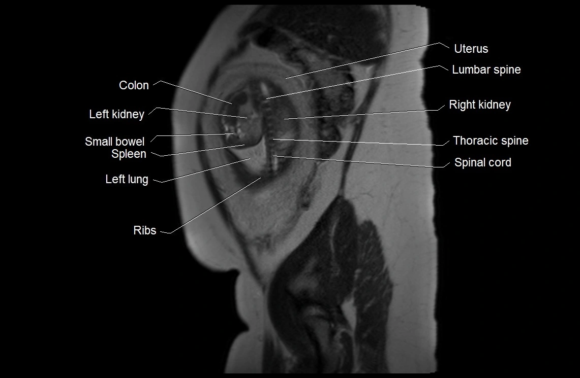 MRI fetal anatomy sagittal image 6.webp